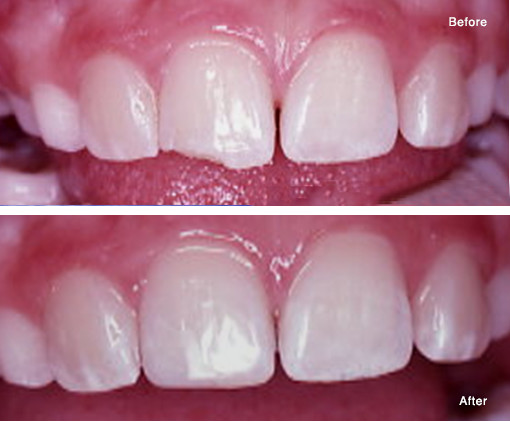 Repair of a Chipped Tooth with a Simple Bonded Composite