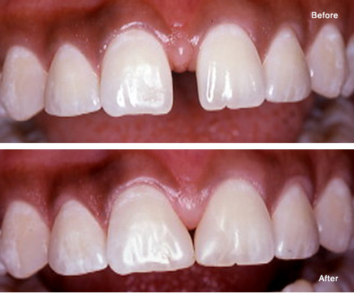 Closing a Space (Diastema) with a Simple Bonded Composite Fill