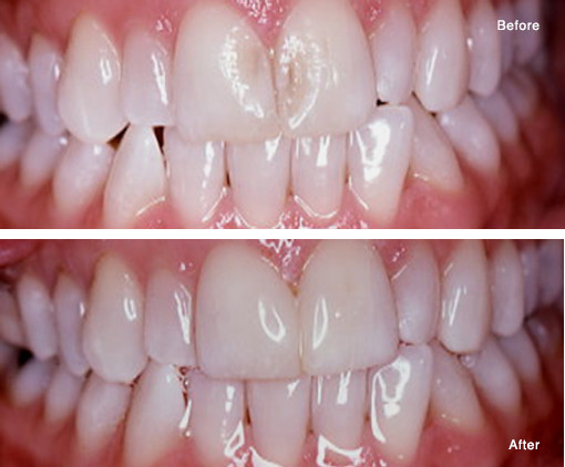 Repair of Eroded Enamel with a Simple Bonded Composite Fill