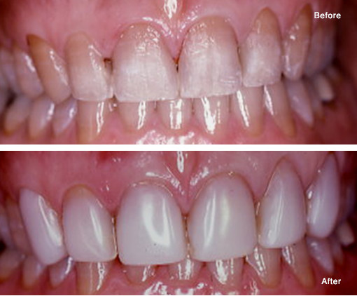 Tetracycline Stained Teeth Masked with Bonded Composite Veneers