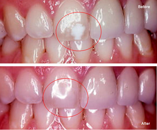 Repair of a Decalcified Area with a Simple Bonded Composite Fill