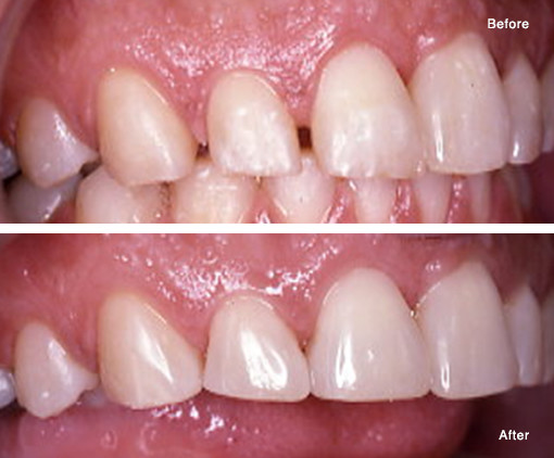 Closing a Space (Diastema) with Porcelain Veneers