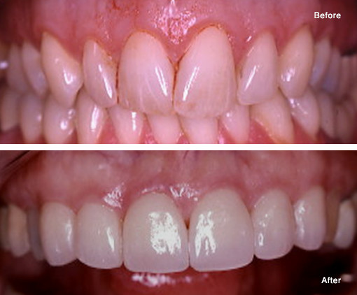 Custom Laboratory Processed Porcelain Veneers