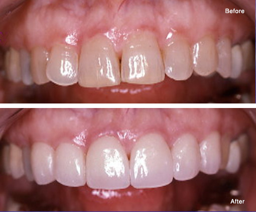 Custom Laboratory Processed Porcelain Veneers